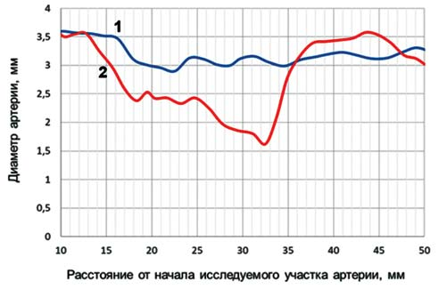 Рис. 2. Распределение диаметра по длине участка ПМЖВ с мостиком в конце диастолы (1) и в конце систолы (2) ЛЖ.