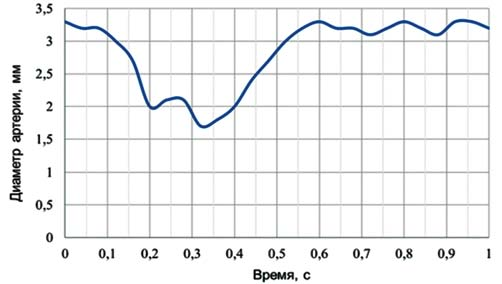 Рис. 3. Изменение диаметра пережимаемого участка ПМЖВ во времени. Конечно-диастолический кадр соответствует моменту 0,04 с, конечно-систолический — 0,4 с.