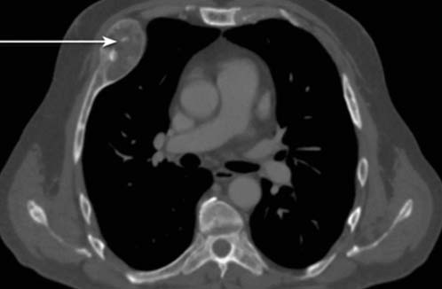 Рис. 1а. КТ грудной клетки, аксиальная плоскость (костное окно): участок литической деструкции в переднем отрезке 4-го ребра справа (белая стрелка).