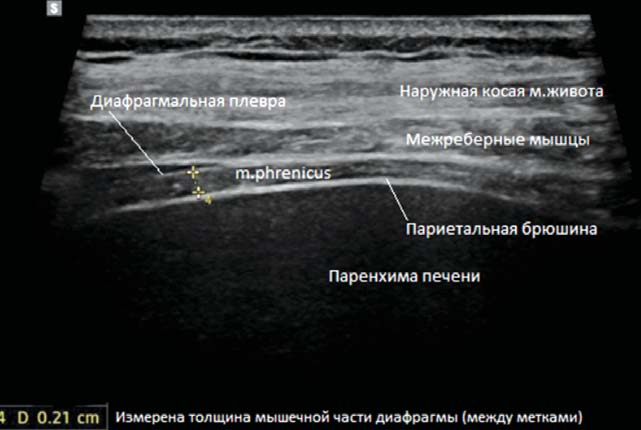 Рис. 2а. ИФР (т) правой половины диафрагмы при первом УЗИ у пациентов подгрупп НИВЛ и ИВЛ.