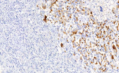 Рис. 5г. ИГХ: очаговая экспрессия Pancytokeratin в саркоматоидной недифференцированной карциноме.