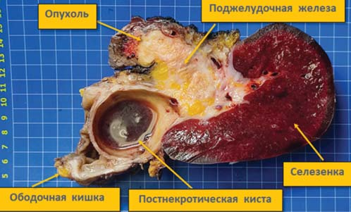Рис. 6. Удаленный макропрепарат, разрез во фронтальной плоскости: опухоль, поджелудочная железа, постнекротическая киста, селезёнка, ободочная кишка.
